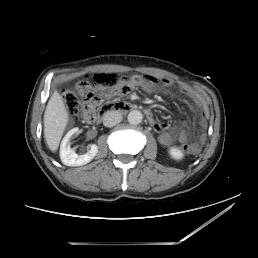Closed loop small bowel obstruction - omental adhesion causing "internal hernia" (Radiopaedia 85129-100682 A 71).jpg