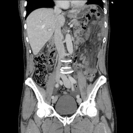 Closed loop small bowel obstruction - omental adhesion causing "internal hernia" (Radiopaedia 85129-100682 B 64).jpg