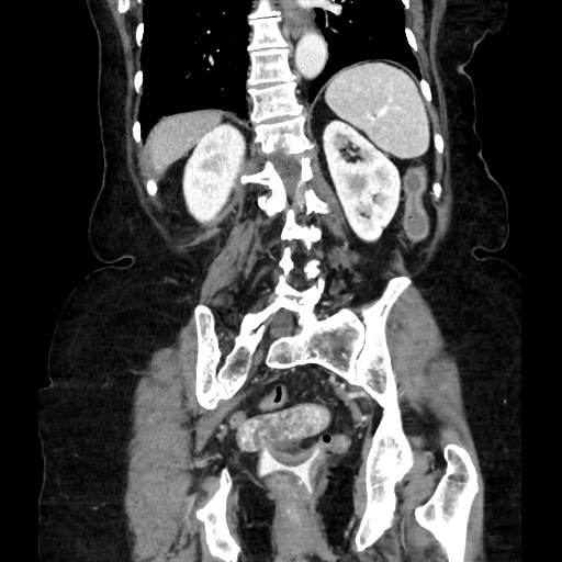 Closed loop small bowel obstruction due to adhesive band, with intramural hemorrhage and ischemia (Radiopaedia 83831-99017 C 90).jpg