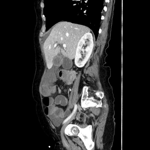 Closed loop small bowel obstruction due to adhesive band, with intramural hemorrhage and ischemia (Radiopaedia 83831-99017 D 78).jpg