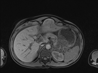 Closed loop small bowel obstruction in pregnancy (MRI) (Radiopaedia 87637-104031 Axial T1 fat sat 32).jpg