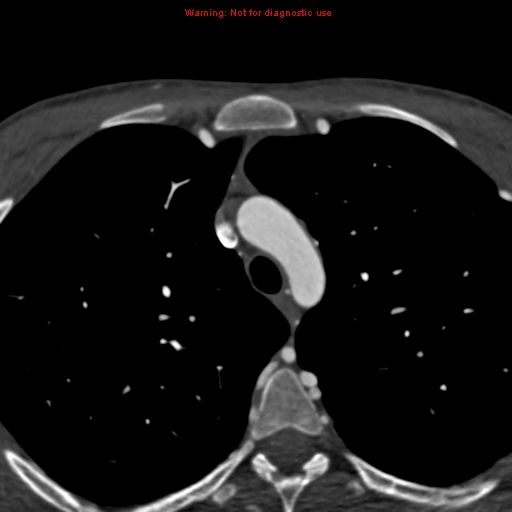 File:Coarctation of the aorta (Radiopaedia 12461-12697 A 51).jpg