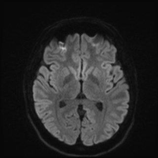 File:Cochlear incomplete partition type III associated with hypothalamic hamartoma (Radiopaedia 88756-105498 Axial DWI 61).jpg