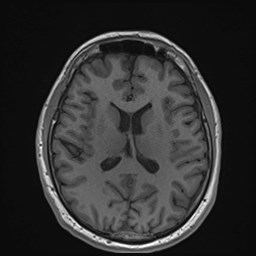 Cochlear incomplete partition type III associated with hypothalamic hamartoma (Radiopaedia 88756-105498 Axial T1 117).jpg