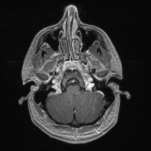 File:Colloid cyst (Radiopaedia 44510-48181 Axial T1 C+ 41).png