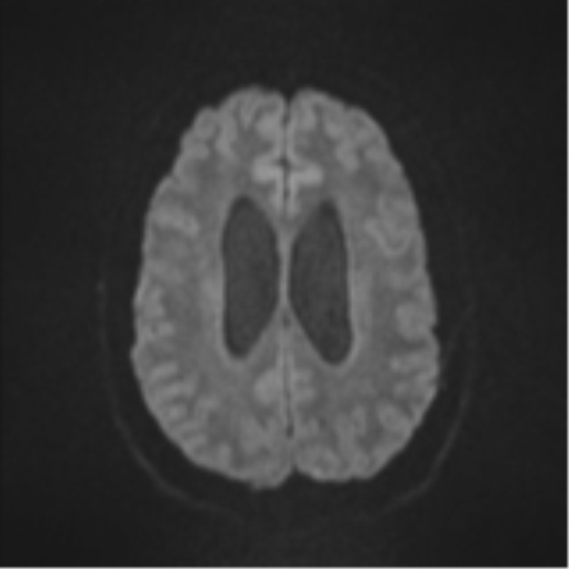 Colloid cyst (Radiopaedia 53164-59125 Axial DWI 47).png