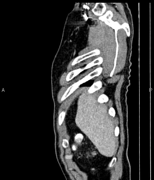 Colon adenocarcinoma (Radiopaedia 83266-97671 D 14).jpg