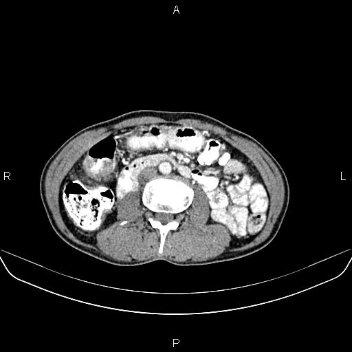 Colon adenocarcinoma - hepatic flexure (Radiopaedia 85635-101395 A 45).jpg