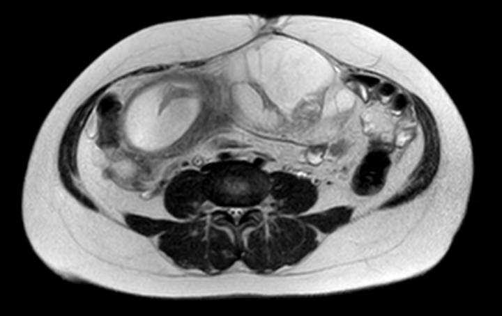 File:Colon adenocarcinoma with Krukenberg tumors, advanced pregnancy (Radiopaedia 67279-76645 Axial T2 35).jpg