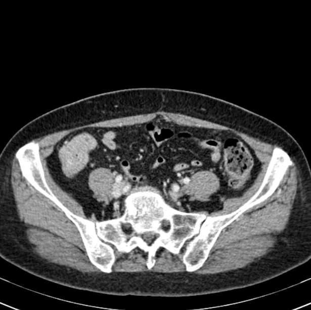 Colon carcinoma with hepatic metastases (Radiopaedia 29477-29961 A 83).jpg