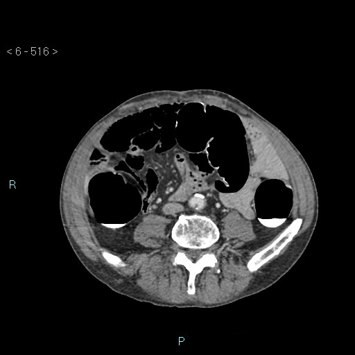 File:Colonic cancer (ultrasound and TC imaging) (Radiopaedia 50346-55713 A 70).jpg