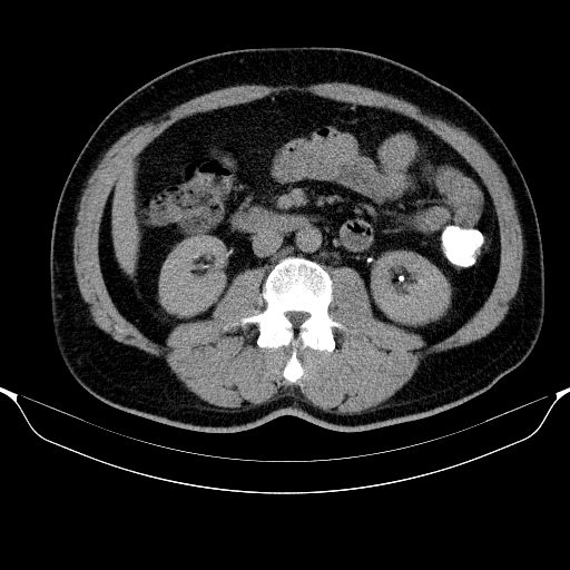File:Colonic lipoma with colo-colic intussusception (Radiopaedia 58944-66200 Axial 109).jpg