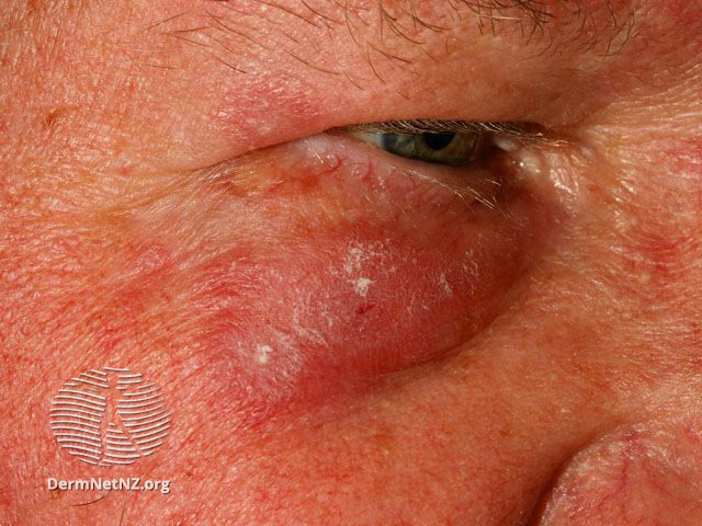 Cutaneous lupus erythematosus (DermNet NZ immune-lupus-erythematosus-2529).jpg