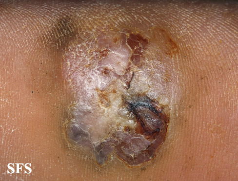 File:Melanoma (Dermatology Atlas 77).jpg