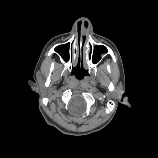 Nasal pyogenic granuloma (lobular capillary hemangioma) (Radiopaedia 85536-101244 Axial non-contrast 28).jpg