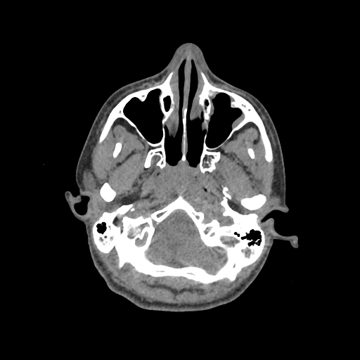 Nasal pyogenic granuloma (lobular capillary hemangioma) (Radiopaedia 85536-101244 Axial non-contrast 53).jpg