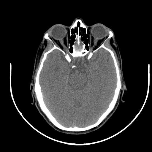 File:Nasopharyngeal carcinoma - infiltrating the clivus (Radiopaedia 62583-70875 Axial non-contrast 2).jpg