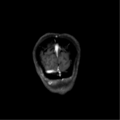 Nasopharyngeal carcinoma with cerebral abscess (Radiopaedia 43018-46274 L 52).png