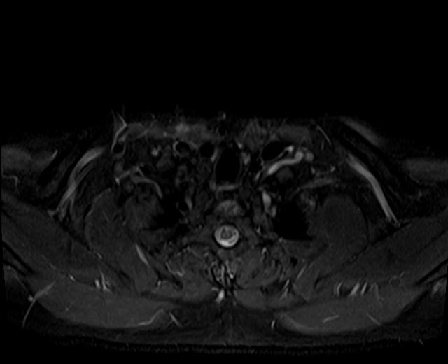 File:Nasopharyngeal carcinoma with perineural spread (Radiopaedia 55030-61380 Axial STIR 2).jpg