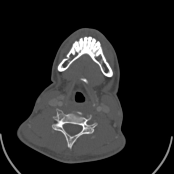 Nasopharyngeal carcinoma with skull base invasion (Radiopaedia 53415-59705 Axial bone window 140).jpg