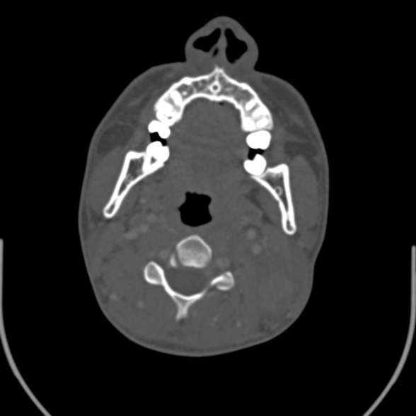 Nasopharyngeal carcinoma with skull base invasion (Radiopaedia 53415-59705 Axial bone window 94).jpg