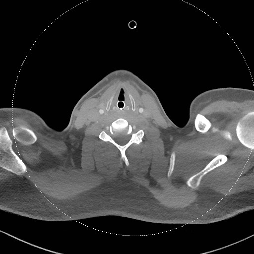 Neck CT angiogram (intraosseous vascular access) (Radiopaedia 55481-61945 B 154).jpg