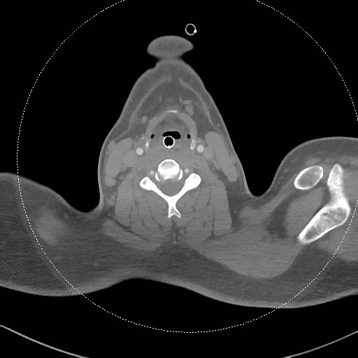 Neck CT angiogram (intraosseous vascular access) (Radiopaedia 55481-61945 B 171).jpg
