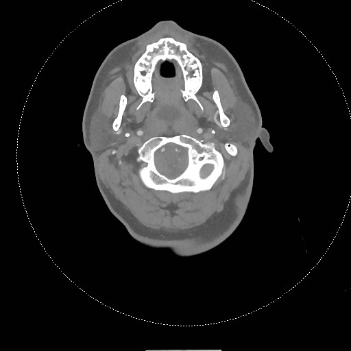 Neck CT angiogram (intraosseous vascular access) (Radiopaedia 55481-61945 B 245).jpg