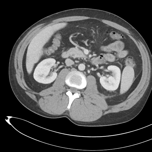 File:Necrotizing pancreatitis with acute necrotic collections (Radiopaedia 38829-41012 B 37).png