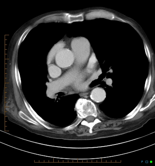 Necrotzing fasciitis due to a perforated adenocarcinoma of the splenic flexure (Radiopaedia 46930-51455 A 3).jpg