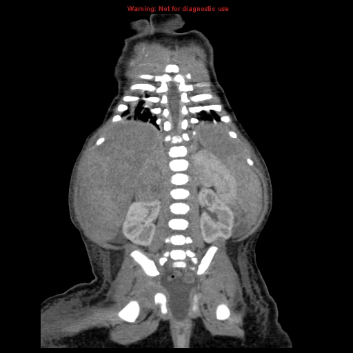 File:Neonatal neuroblastoma (Radiopaedia 9564-10223 B 92).jpg