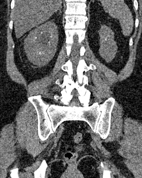 File:Nephrostomy for urosepsis (Radiopaedia 26180-26330 non-contrast 65).jpg