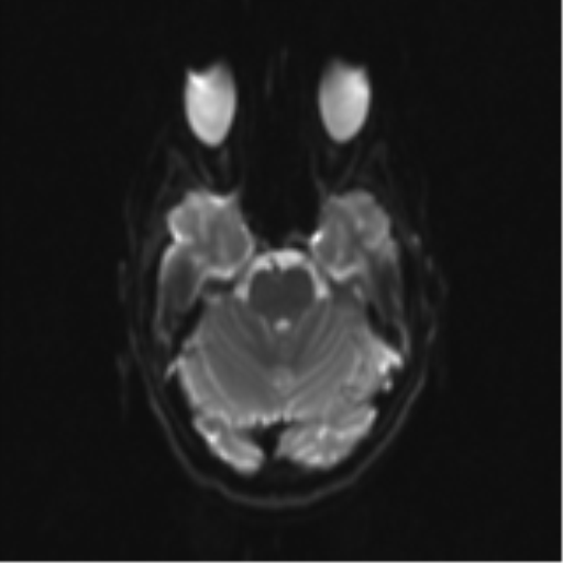 Neurenteric cyst (Radiopaedia 58641-65837 Axial DWI 12).png