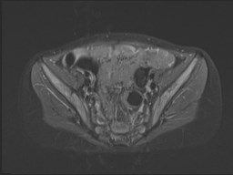File:Neuroblastoma with bone metastases (Radiopaedia 67080-76414 Axial STIR 55).jpg