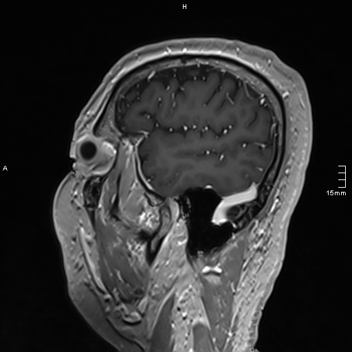 Neurosarcoidosis - involvement of the mesial temporal lobes (Radiopaedia 67429-76820 Sagittal T1 C+ 35).jpg