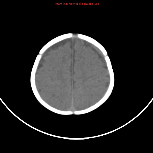 File:Non-accidental injury - bilateral subdural with acute blood (Radiopaedia 10236-10765 Axial non-contrast 18).jpg