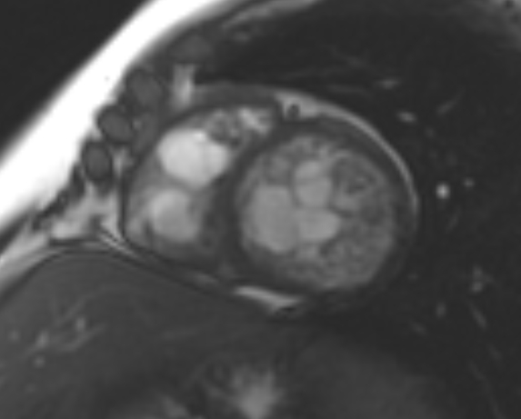 File:Non-compaction of the left ventricle (Radiopaedia 69436-79314 Short axis cine 113).jpg