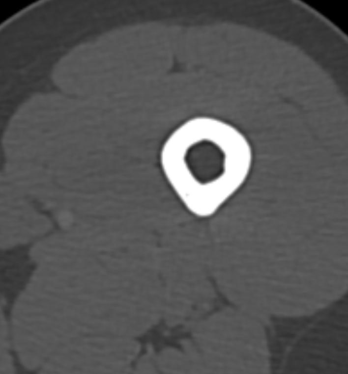 Non-ossifying fibroma - femur (Radiopaedia 82786-97042 Axial bone window 4).jpg