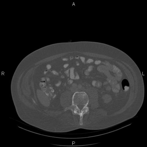 Non Hodgkin lymphoma in a patient with ankylosing spondylitis (Radiopaedia 84323-99624 Axial bone window 45).jpg