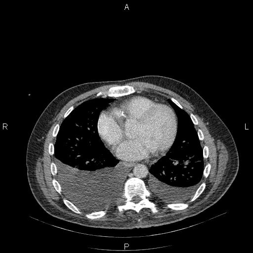 File:Non Hodgkin lymphoma in a patient with ankylosing spondylitis (Radiopaedia 84323-99624 B 19).jpg