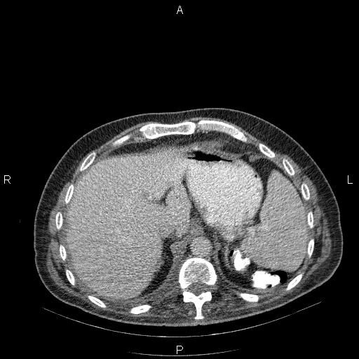 File:Non Hodgkin lymphoma in a patient with ankylosing spondylitis (Radiopaedia 84323-99624 B 27).jpg