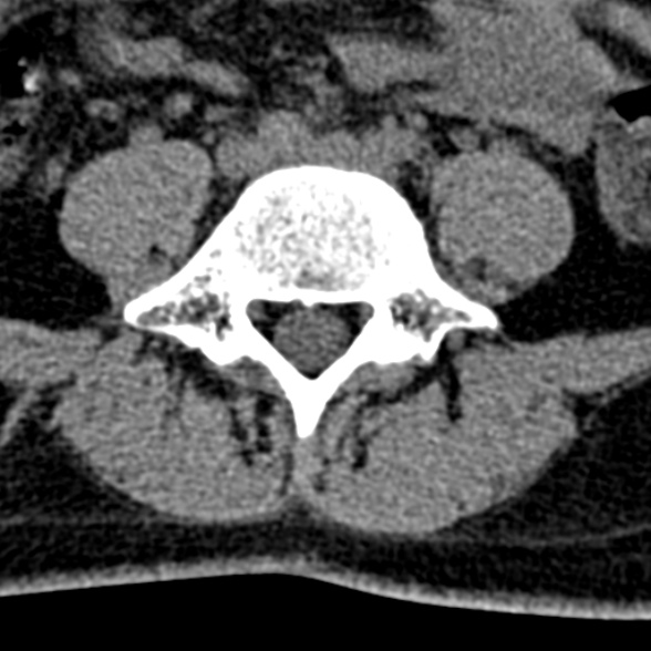 Normal CT lumbar spine (Radiopaedia 53981-60118 Axial non-contrast 76).jpg