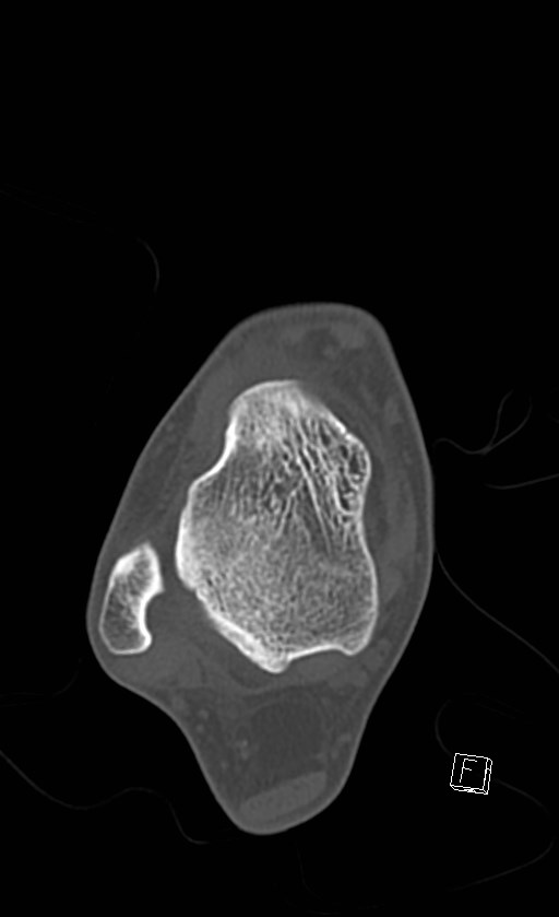 Normal CT of the ankle (Radiopaedia 47111-51658 Axial bone window 50).jpg