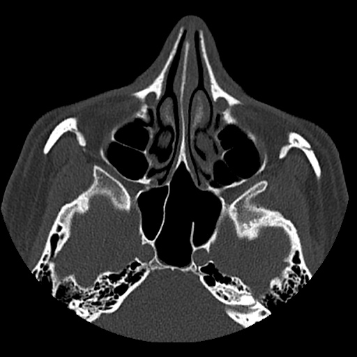 Normal CT paranasal sinuses (Radiopaedia 42286-45390 Axial bone window 61).jpg