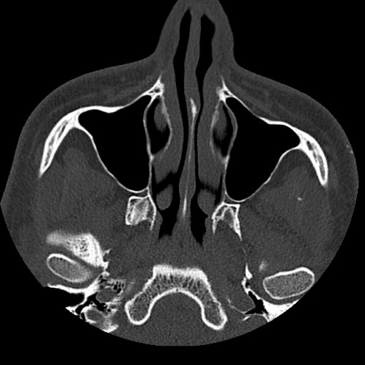 Normal CT paranasal sinuses (Radiopaedia 42286-45390 Axial bone window 77).jpg
