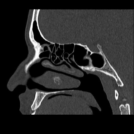 Normal CT paranasal sinuses (Radiopaedia 42286-45390 Sagittal bone window 44).jpg