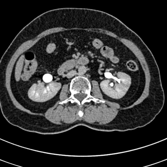 File:Normal CT split bolus study of the renal tract (Radiopaedia 48631-53634 Axial split bolus 96).jpg