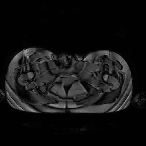 File:Normal MRI abdomen in pregnancy (Radiopaedia 88001-104541 Axial Gradient Echo 58).jpg