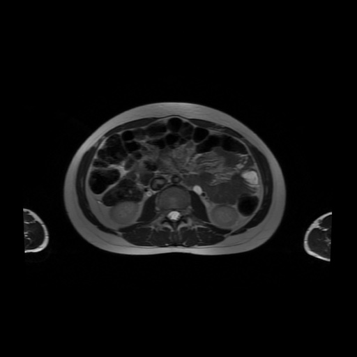 File:Normal MRI abdomen in pregnancy (Radiopaedia 88001-104541 Axial T2 31).jpg