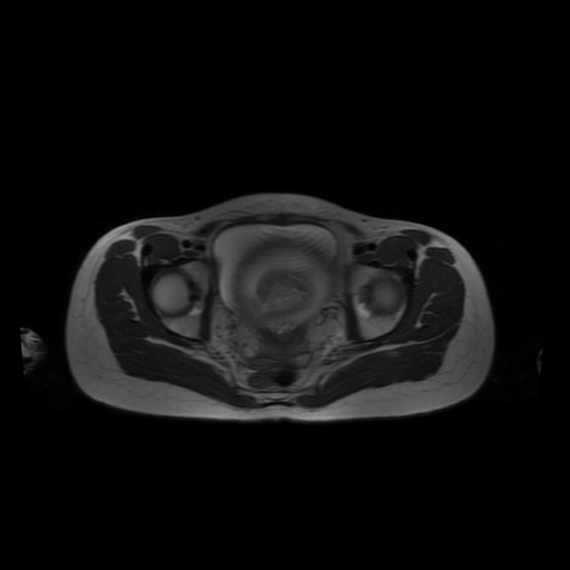 File:Normal MRI abdomen in pregnancy (Radiopaedia 88001-104541 Axial T2 64).jpg